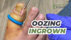 Oozing Ingrown | Blistering Nail Bed